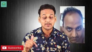 HAIR TRANSPLANT| 5 Reasons Your Hair Transplant Will Fail For Sure| A Must Watch